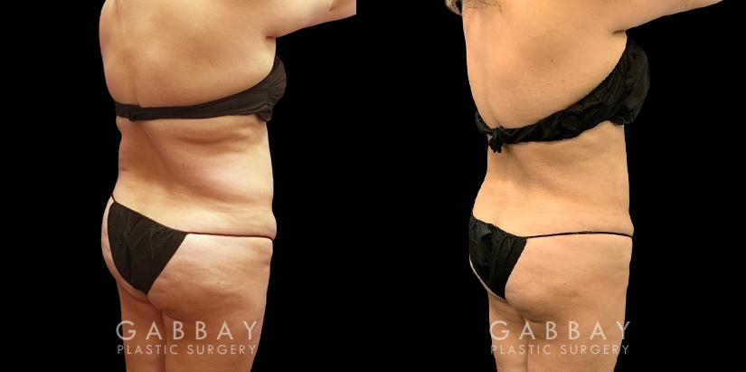 Mid 40s female patient after abdominal liposuction results have full healed, showing a tightened lower torso with belly rolls smoothed out for a flatter overall contour.