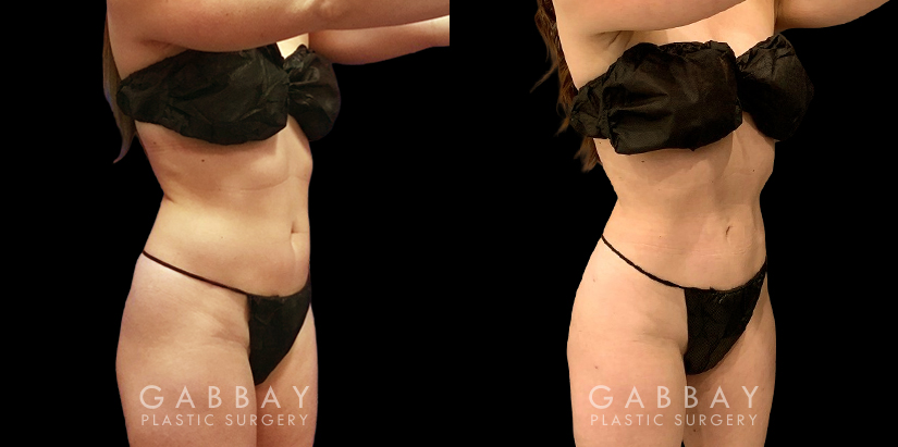 Late 20s female patient with minor stubborn fat wanted to complete her efforts to lose weight. Stomach area liposuction allowed her to achieve a flat abdominal area that looks great from every angle.