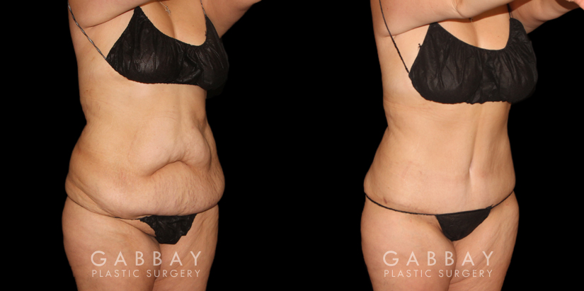 Note the significant tightening of the loose pockets of skin and stubborn fat around the abdomen following weight loss. After her tummy tuck, this patient saw a flattened stomach and enjoyed the benefits of her effort to lose weight.