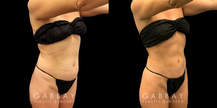 Before-and-after liposuction for the abdomen, showcasing the patient’s flatter stomach. Note how her abdominal muscle contouring is now visible, lending an exceedingly fit aspect to her aesthetic.