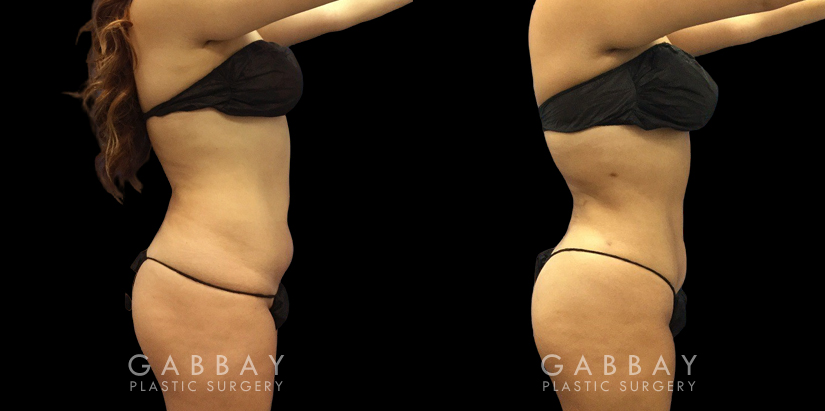 Female patient with enhanced abdominal contours after 360 liposuction surgery. Note the flattened stomach and the dynamic shape to her waist, restoring her natural curves.