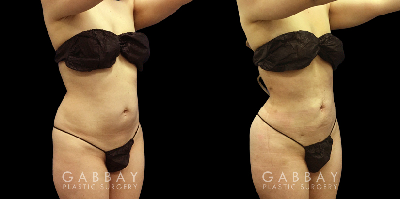 Before-and-after photo for 360 and abdominal liposuction combination. Note the emphasized contour of the waist, which in turn emphasizes the roundness of the buttocks.