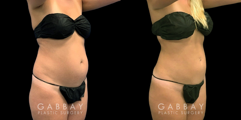 Patient after mild liposuction, demonstrating a significantly flatter stomach area from the profile angle. Patient’s recovery was without complications, and lead to virtually no visible scarring.