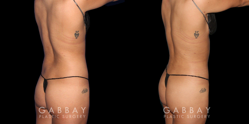 Before-and-after for patient with combined cosmetic surgeries, including BBL, abdominal lipo. Note the 360-degree slimming with enhanced buttocks roundness from the natural fat transfer.