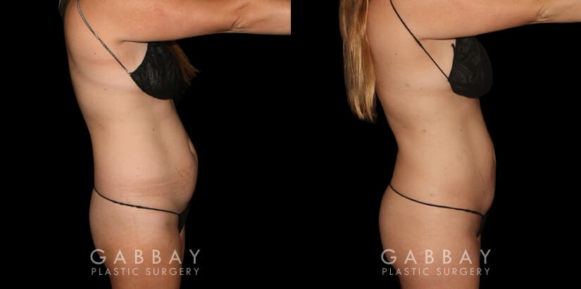 Results for a patient with 360 liposuction for abdomen, waist, and tailbone for a BBL fat transfer surgery. Note the flattened stomach and enhanced shape of the buttocks for a more impressive figure overall.