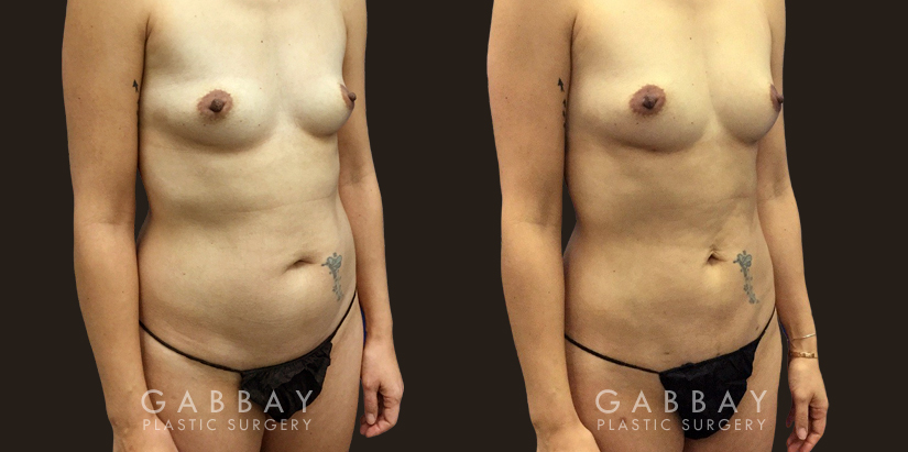 Patient sought to remove final stubborn pockets of belly fat, restoring a more youthful figure and enhancing her natural figure.