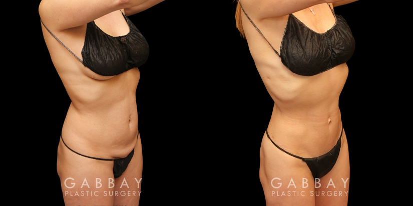 Patient with combined abdominal liposuction with liposuction targeting stubborn fat bulges on her back. The combined procedure restored a youthful figure and slimmed contours.