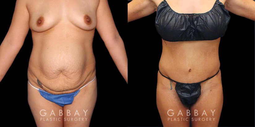 Before and after tummy tuck combined with hernia repair. By removing fat, tightening loose skin, and repairing the abdominal wall, Dr. Gabbay restored a slimmer, healthy appearance to the stomach area and tissues.