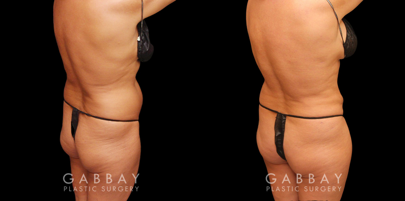 Female African-American patient after liposuction and J plasma treatment to her full abdomen, reducing her bulging belly and to tighten and restore loose skin.