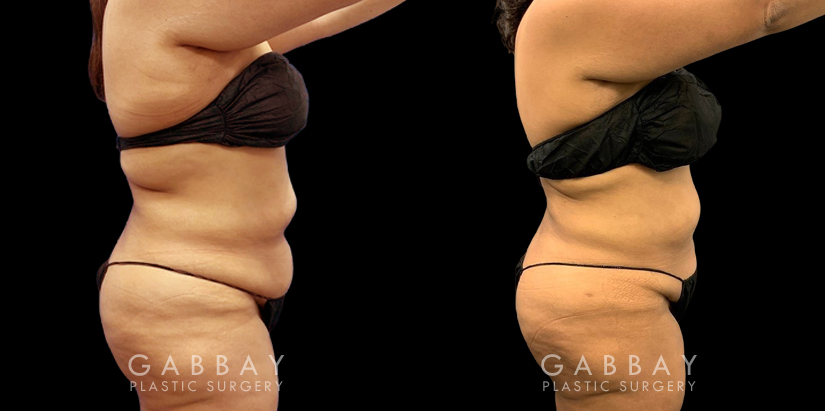 Patient after a traditional liposuction for the stomach (abdominal) area, resulting in a decrease in bulging belly fat (rolls) with a notable restoration of her natural body shape.