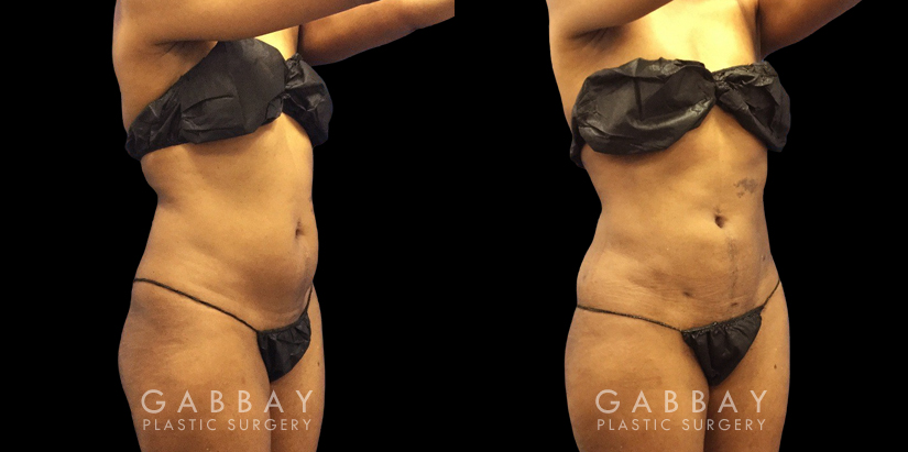 Female patient with notable contouring of the abdominal area after liposuction, resulting in a more youthful figure free from any bulging fat deposits.
