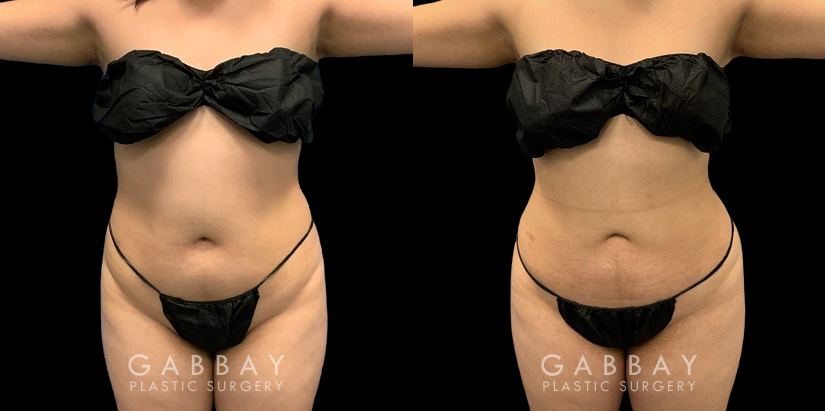 Patient who wanted mild liposuction to reduce tummy bulge from stubborn fat, with subtle results that lend a more balanced figure. Note how the puncture sites healed well for little to no visibility.