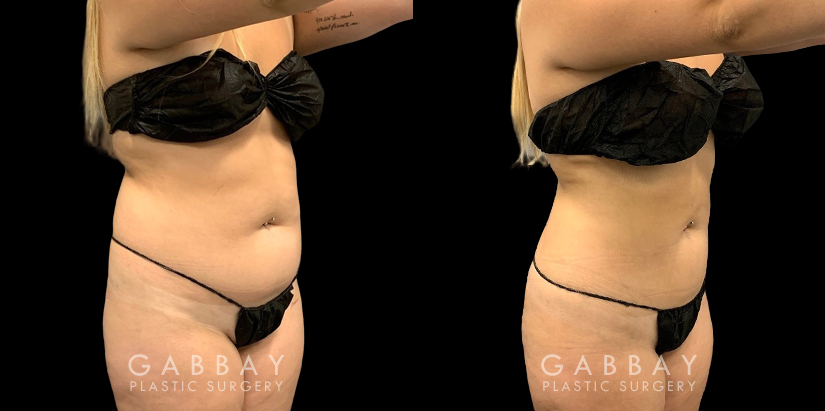 Before and after liposuction surgery for reducing mild bulging pockets of fat on the upper and lower abdomen, restoring a tighter stomach appearance without and bulging fat.