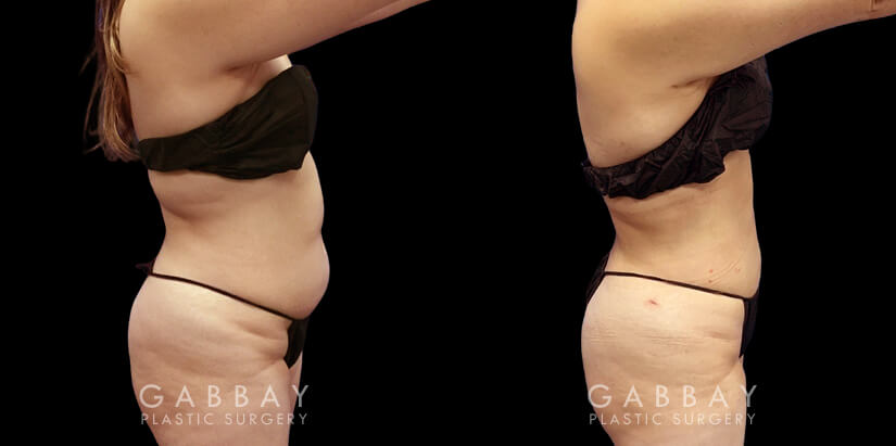 Abdominal liposuction results for a Caucasian patient who wanted to address pockets of belly fat that would not go away. The procedure removed the fat and produced a flat profile with a tighter tummy appearance.