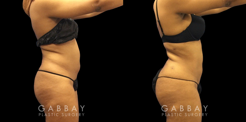 Younger female patient showcasing her results after belly fat removal via liposuction surgery. Note the reduction of ‘love handles’ and a flatter stomach for a defined lower torso aesthetic.