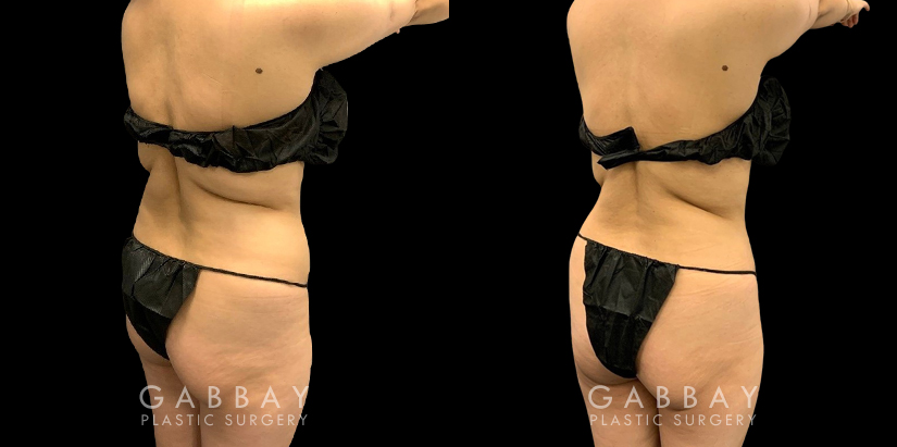 Patient with mild liposuction for the abdomen to help reduce some of the stubborn pockets of fat while also slimming the waist for a renewed youthful shape.