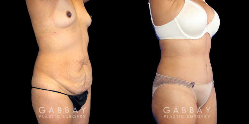 Patient before and after plastic surgery combination procedure involving breast augmentation (silicone implants), tummy tuck, and liposuction of the flanks. The combined results show a slimmer, more youthful profile with an enhanced feminine shape.