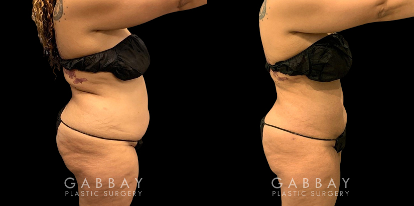 Patient who wanted to address a more significant amount of fat over the belly area. Using targeted liposuction, Dr. Gabbay removed the fat while keeping a balanced shape and aesthetic to the abdominal area.