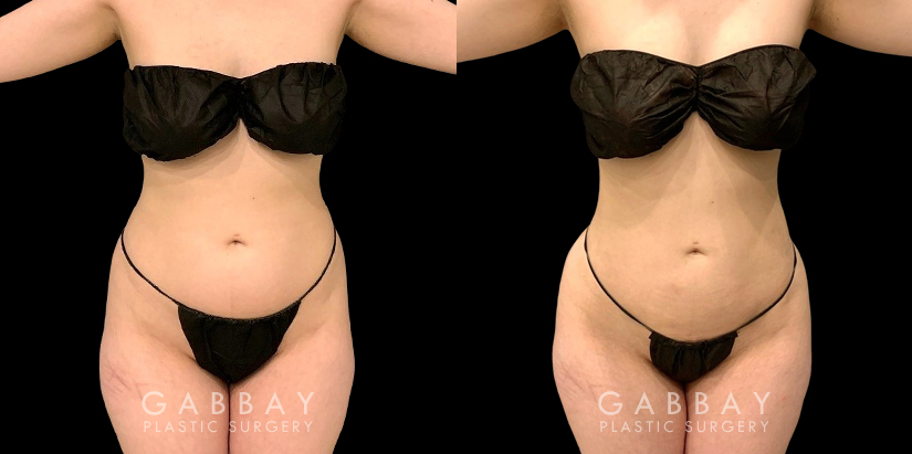 Liposuction results for fat removal along the tailbone, waist, and abdomen, resulting in emphasis of natural curves for a youthful, rejuvenating aesthetic to become visible.