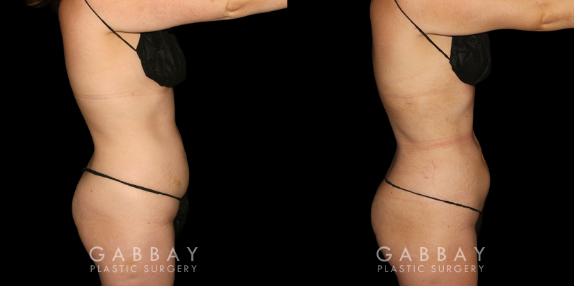 Before-and-after photos for female patient who underwent both a breast lift and belly fat removal via liposuction. Results together create a full ‘lifted’ appearance for the patient’s entire body.