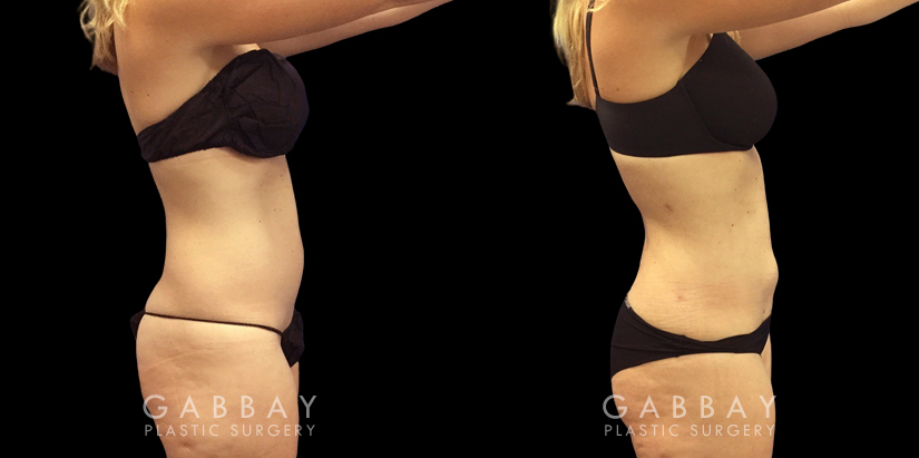 Front and side views of before and after liposuction for female patient. The surgery resulted in a flatter stomach with no notable bulging pockets of fat.