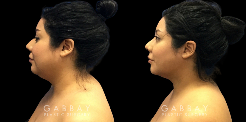 Patient 08 Left Side View Lipo Neck Gabbay Plastic Surgery