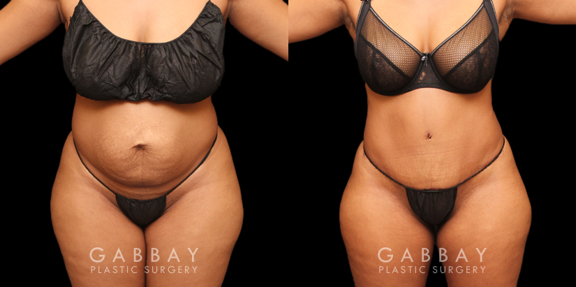 Tummy tuck patient before and after her procedure. Photos demonstrate the lack of visible scarring, a flattened abdomen, and removal of stretch marks through precise tightening techniques.