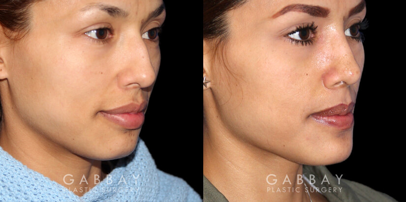 Patient 01 3/4th Right Side View Chin implant, Rhinoplasty, BAM Gabbay Plastic Surgery