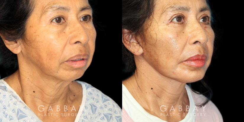 Patient 02 3/4th Right Side View Chin Implant, facelift, Bleph Gabbay Plastic Surgery