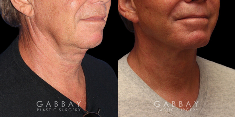 Patient 01 3/4th Right Side View facelift, full neck lift, upper blepharoplasty Gabbay Plastic Surgery