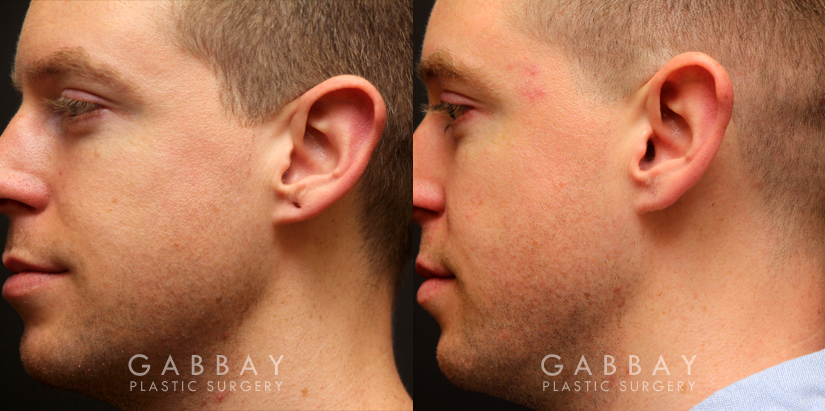 Patient 03 Left Side View Earlobe Repair Gabbay Plastic Surgery