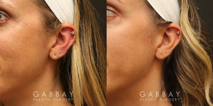 Patient 04 3/4th Left Side View Earlobe Repair Gabbay Plastic Surgery