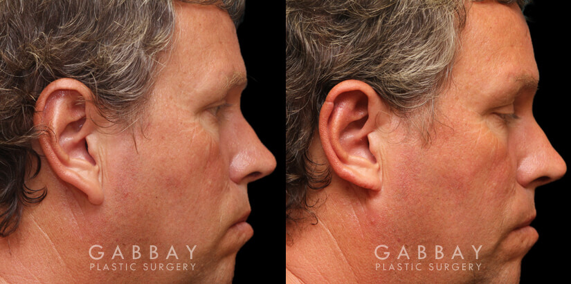 Patient 01 Right Side View Ear reduction Gabbay Plastic Surgery