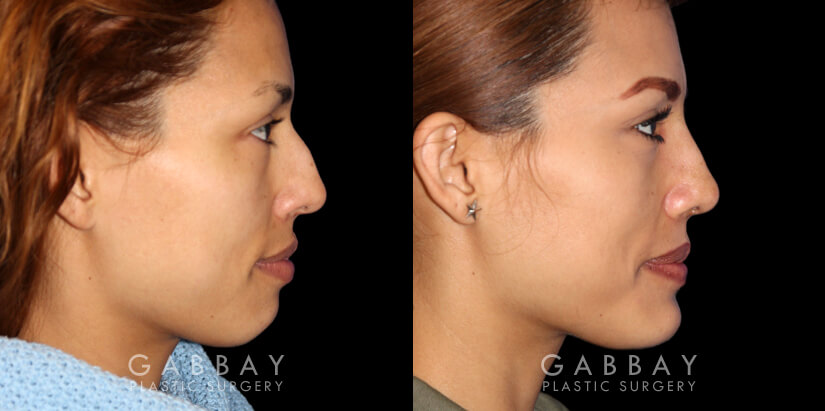 Patient 01 Right Side View Rhinoplasty Gabbay Plastic Surgery