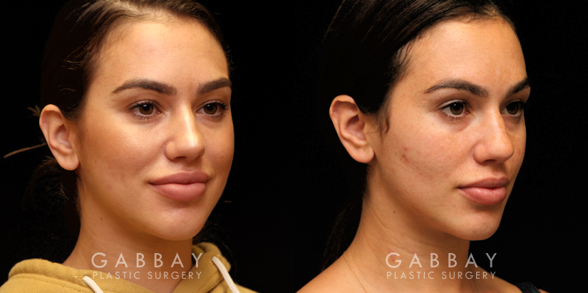 Before and After Buccal Fat Pad Removal Patient 03 3/4th Right Side View Gabbay Plastic Surgery