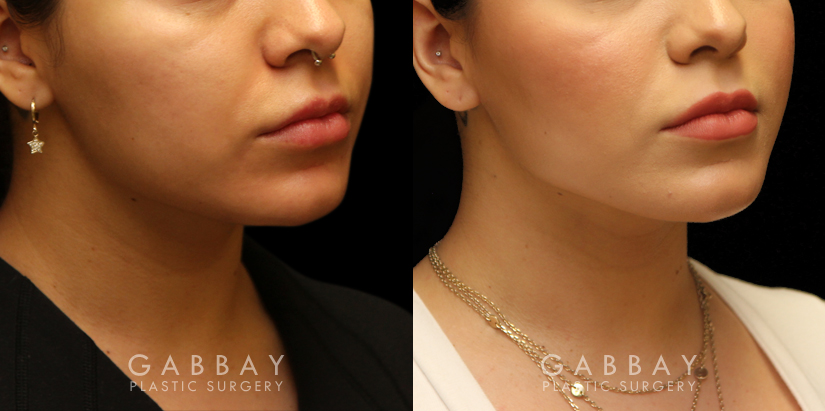 Patient 08 3/4th Right Side View Buccal Fat Removal with Lipo to Chin Gabbay Plastic Surgery