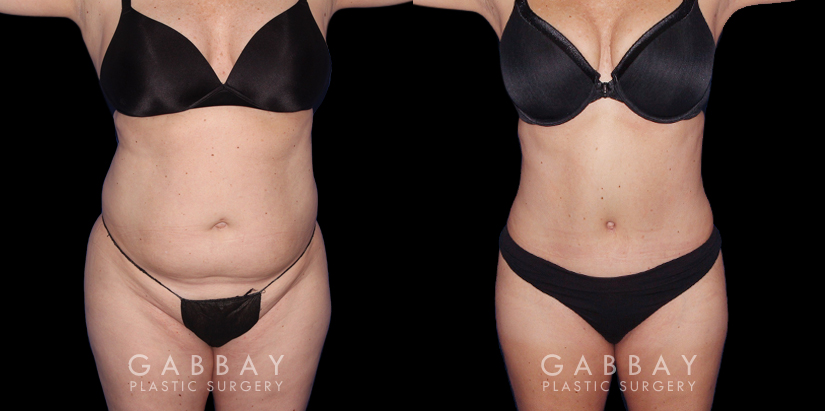 Photos of patient results after a combination of multiple liposuction procedures, each targeting a different area. Liposuction of the back bra roll, arms, and Buffalo hump augmented by abdominal tightening produced a flat, tighter torso from each angle.