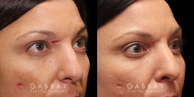Patient 02 3/4th Right View Scar Revision to Eyebrow Gabbay Plastic Surgery