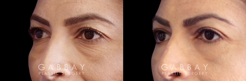 Patient 01 3/4th Left Side View Blepharoplasty Gabbay Plastic Surgery