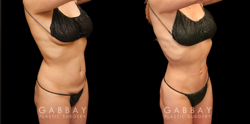 Before and after photos for a mini tummy tuck patient, with combined liposuction around the waist. The combined procedure resulted in notable flattening of the stomach with all fat rolls smoothed out.