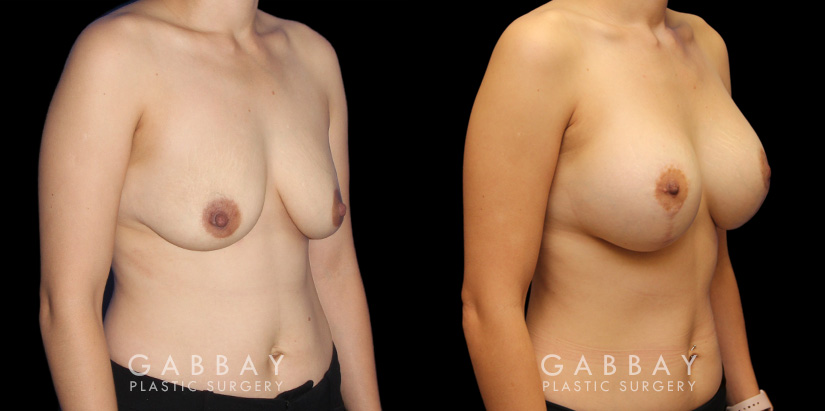 Scar revision to breasts results with additional breast augmentation and lift combination. Patient improved breast size and position with mild scarring only.