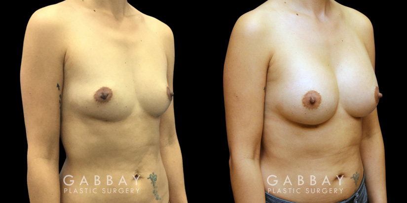 Patient 13 3/4th Right Side View Breast Augmentation Silicone Implants Gabbay Plastic Surgery