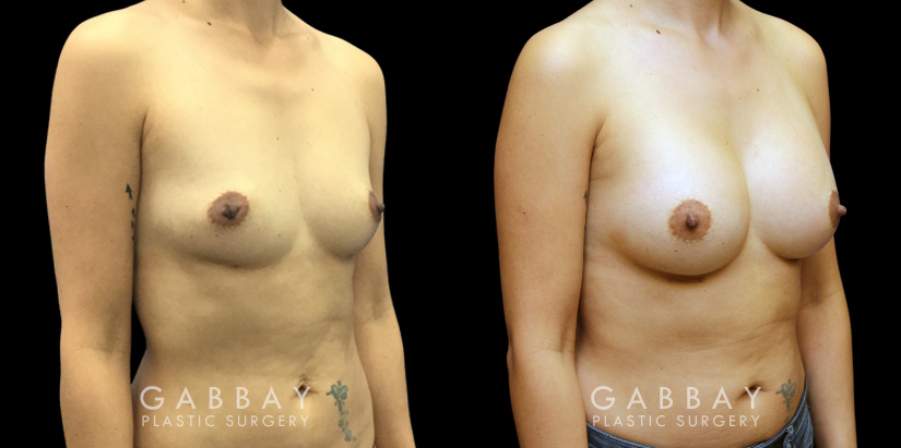 Breast augmentation results for patient in her 40s. Volume increase is mild but retains a natural shape to the breasts with retained symmetry.