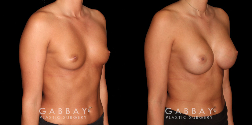 Patient results for breast augmentation. Note the rounded shape and lack of visible scarring. Patient’s recovery was smooth, absent of complications.