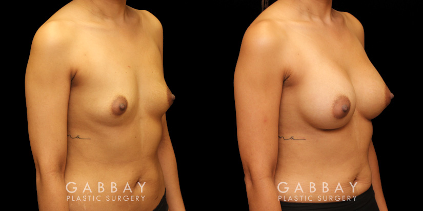 Patient 15 3/4th Right Side View Breast Augmentation Silicone Implants Gabbay Plastic Surgery