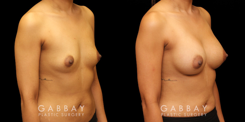 Before and after silicone implants for female patient. Her breast augmentation went smoothly and the recovery was without complications.