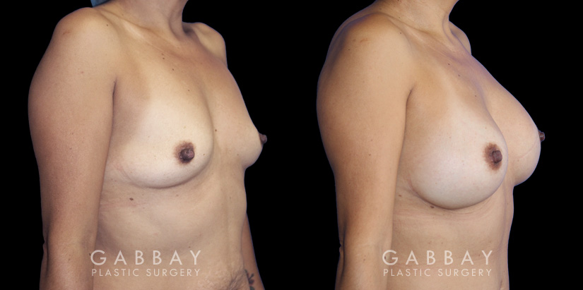 Breast augmentation results including silicone implant augmentation combined with tummy tuck and flank liposuction. The final result is a tightened body contour with enhanced breast size.