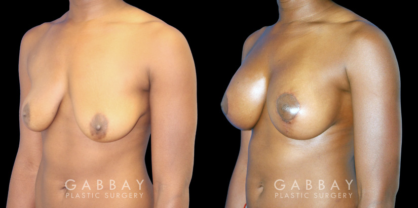 Silicone breast augmentation before-and-after photos demonstration enhanced breast size. Patient combined augmentation with a breast lift for improved breast position as well.