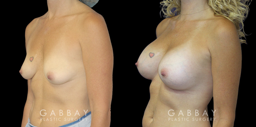 Patient in her mid 40s following breast augmentation. Before-and-after photos show her fully healed results from each angle, demonstrating the improved breast volume.