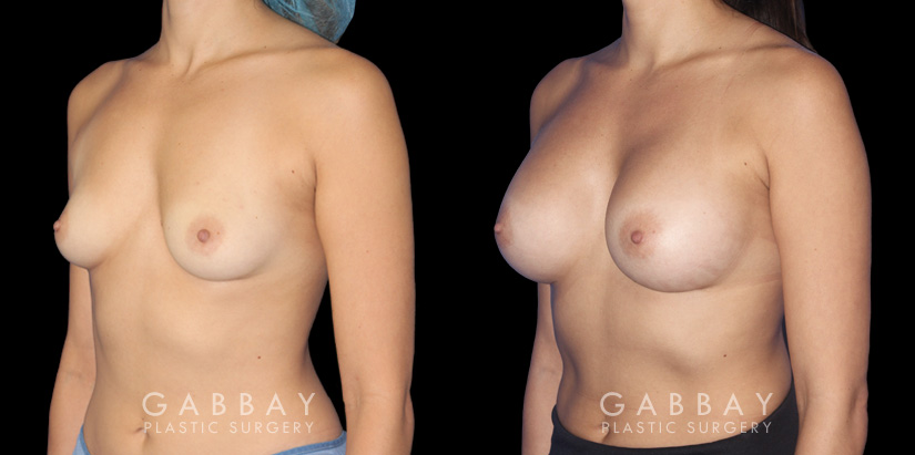 Breast augmentation before-and-after photos for female patient. Final results healed well, matching her body shape and contour well.